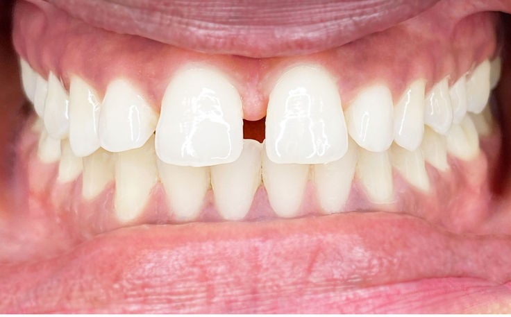 After cosmetic dental treatment, sample image