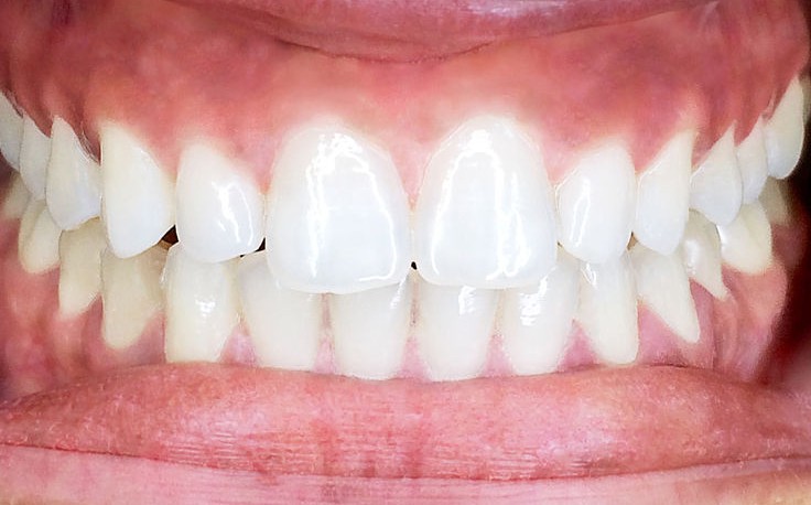 Before cosmetic dental treatment, sample image