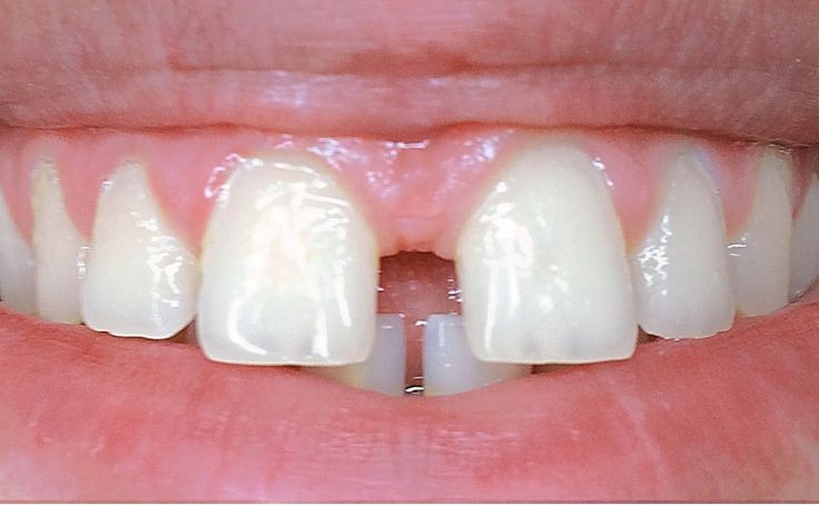 After orthodontic treatment, sample image