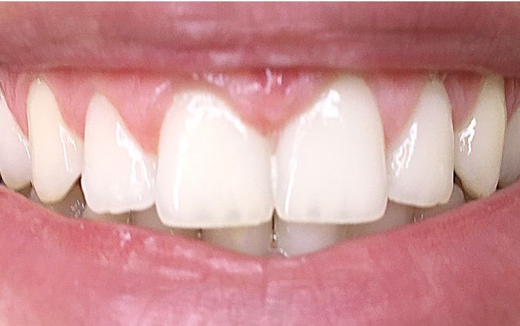 Before orthodontic treatment, sample image