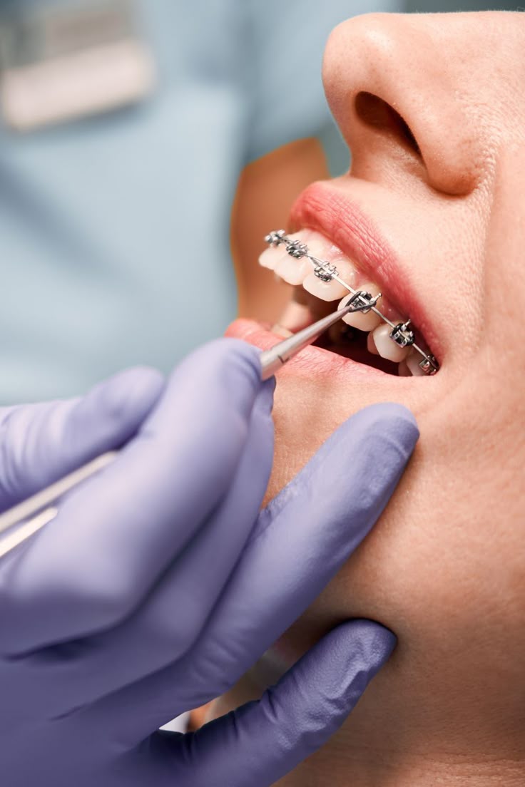 Invisible Braces at Pinak Dental Clinic (sample image)